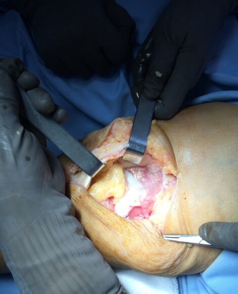 arthroscopy pack